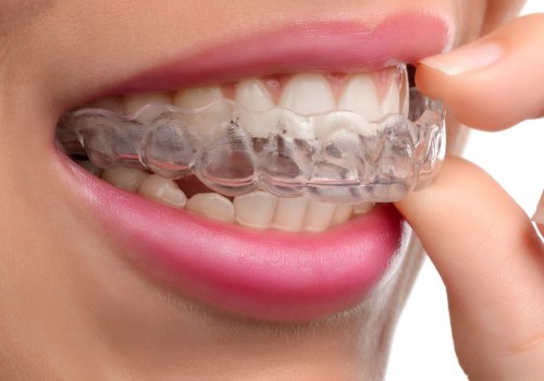 Difference Between SureSmile and Invisalign