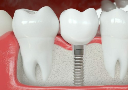 Comparing Dental Implants to Other Tooth Replacement Options