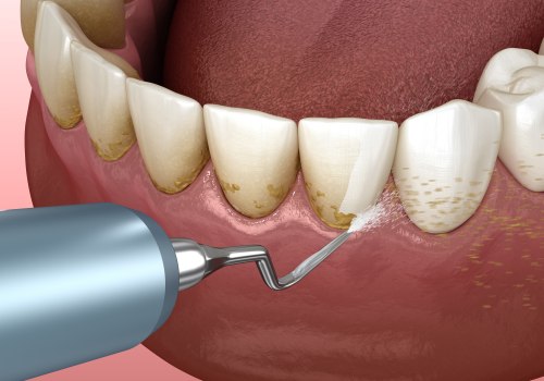 Tips for Maintaining Healthy Gums and Preventing Gum Disease